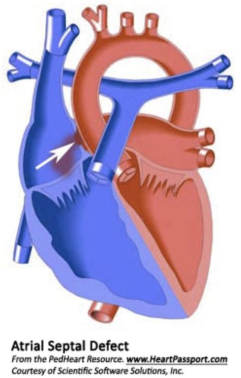 Atrial Septal Defect Heart Conditions Asd Septum Conditioner