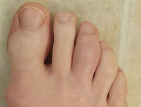 What Causes Stinging At Base Of Middle Toe Nails Bush Morold