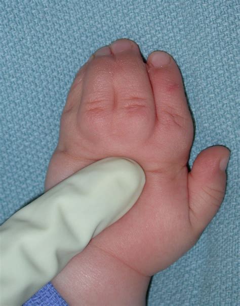 Photo Of Syndactyly Involving Four Fingers Congenital Hand And Arm