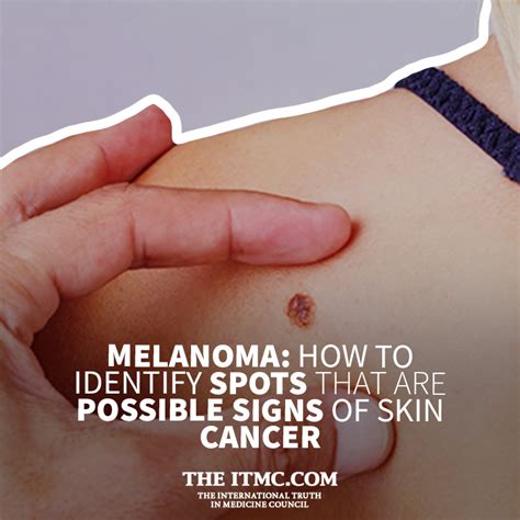 Melanoma How To Identify Spots That Are Possible Signs Of Skin Cancer