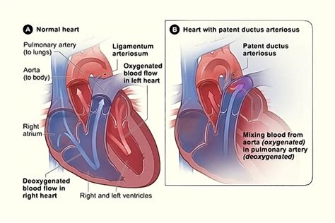 What Is Patent Ductus Arteriosus Storymd