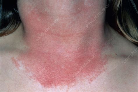 Photosensitive Rash On Womans Neck Stock Image M1400189 Science Photo Library
