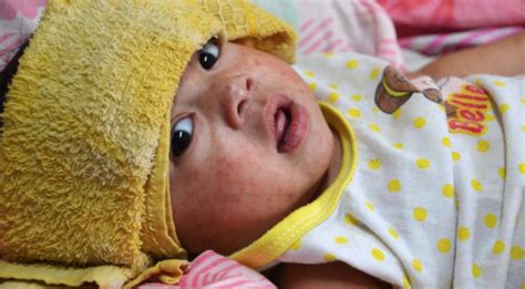 Immune Amnesia Why Measles Is Dangerous For Years After Catching It
