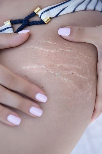 A Woman Is Testing The Skin On The Thigh For The Presence Of Stretch Marks And Cellulite Stock