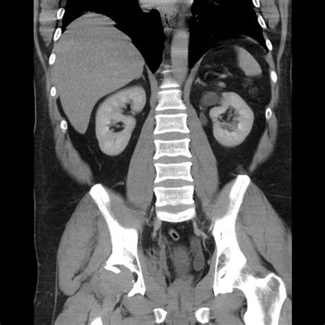 Duplex Kidney And Ureterocoele Radiology Case