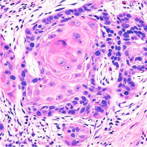 Biopsy Base Of Tongue Well Differentiated Squamous Cell Carcinoma