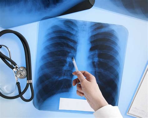 Lung Cancer Lawsuit And Claims Related To Asbestos
