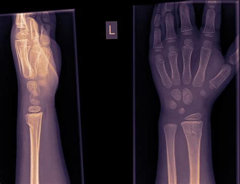 Wrist And Hand X Ray Photograph By Photostock Israel