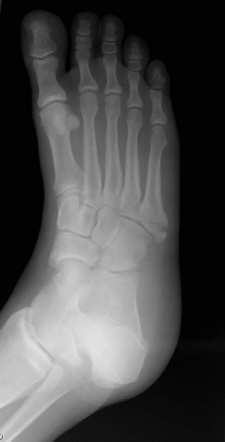 You will need to wear a cast or boot on your foot and. Jones Fracture