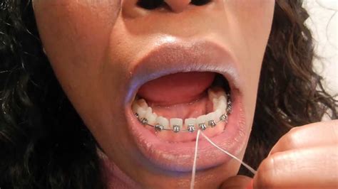 Keep reading to get answers to these. {#32}:HOW TO FLOSS WITH BRACES. FLOSSING TEETH WITH BRACES ...