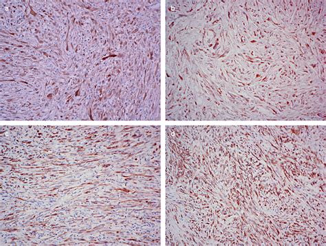 What kind of cancer is a pleural mesothelioma? Differential diagnosis of sarcomatoid mesothelioma from ...
