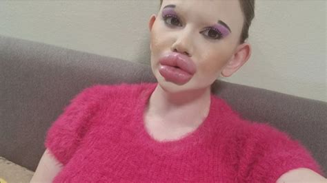 Andrea Ivanova Woman With Worlds Biggest Lips Has Spent Rs 75 Lakh