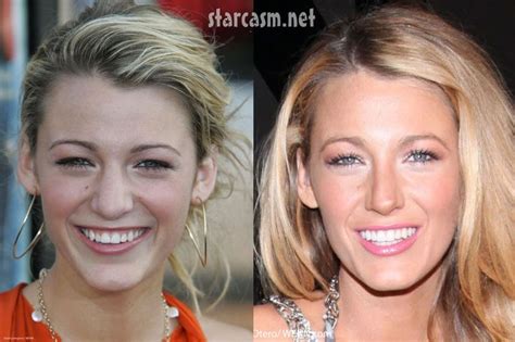 Blake Lively S Nose Job Before And After Plastic Surgery Photos Celebrity Plastic Surgery