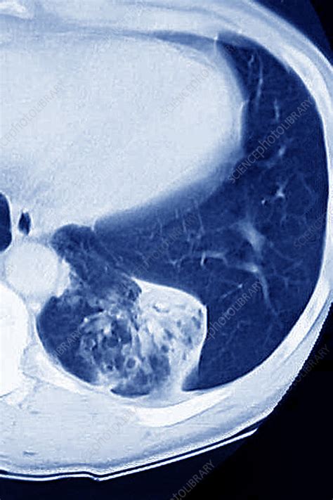 Lung Cancer Ct Scan Stock Image C0269479 Science Photo Library