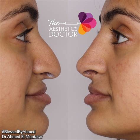 Nose Bumps Non Surgical Rhinoplasty The Aesthetics Doctor
