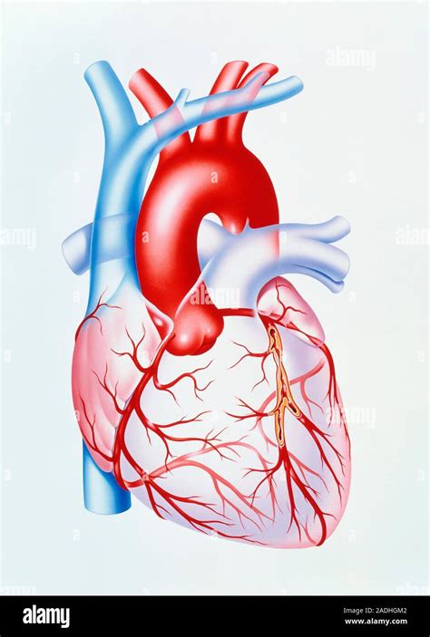 Enfermedad De La Arteria Coronaria Ilustración De Un Corazón Humano