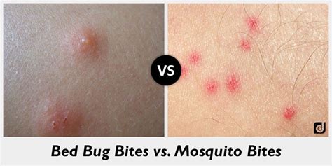 HD What Do Mosquito Bites Look Like On Humans Insectza