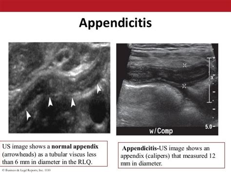 Acute Abdomen Drlalitha