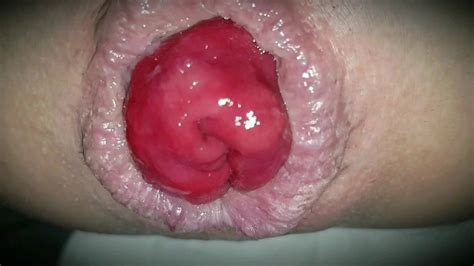Extreme Prolapse Close Up Shemale Anal Masturbating Porn 85 Xhamster