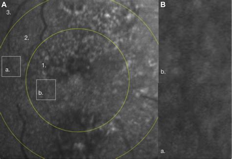 Retinal Imaging Using A Confocal Scanning Laser Ophthalmoscope Based