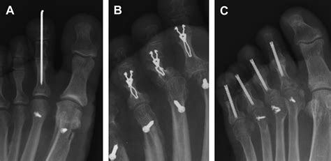 Treatment Of Rigid Hammer Toe Deformity Foot And Ankle Clinics