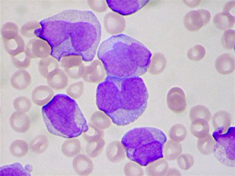 Also Promyelocytic Leukemia Microgranular Variant Looks A Lot Like M5