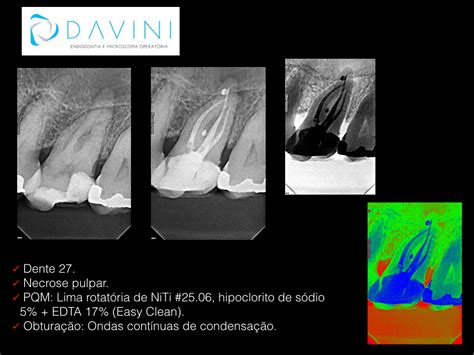 Davini Endodontia e Microscopia Operatória Tratamento Endodôntico dente sessão única