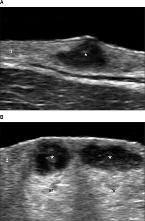 Sonography Of Acne Vulgaris Wortsman 2014 Journal Of Ultrasound