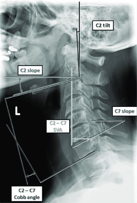 Cervical Alignment Parameters Sva Sagittal Vertical Axis Reprinted