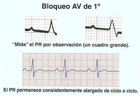 Electrocardiograma Y Medicina General Bloqueos Aurículo Ventriculares