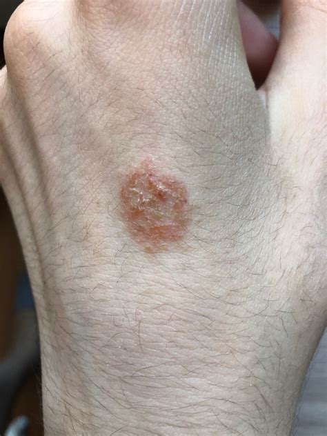 Красное пятно на руке появился месяц назад Вопрос дерматологу 03 Онлайн