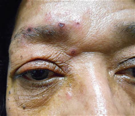 Authored by dr colin tidy, reviewed by dr laurence knott the upper face (including an eye) is also a common site. The Lasting Legacy of Herpes Zoster