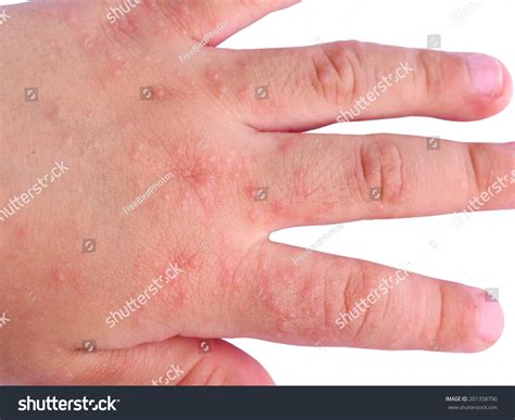 Ill Allergic Rash Dermatitis Eczema Skin Stock Photo 201358790