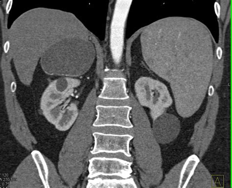 Right Adrenal Cyst With Faint Calcification In The Cyst Wall Adrenal