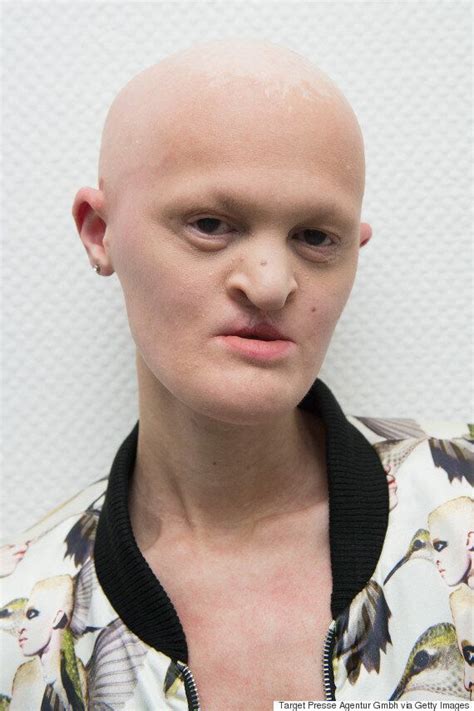 Melanie Gaydos Model With Ectodermal Dysplasia Is Making Waves In The Fashion World Huffpost