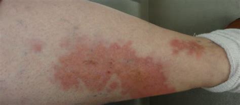 Case Challenge Painless Erythematous Rash On The Lower Extremities