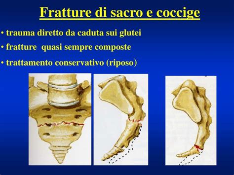 PPT - Fratture vertebrali PowerPoint Presentation - ID:3004151