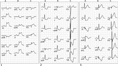 Three Ecgs Presented With Both The Standard Presentation Of Limb Leads
