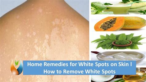 Home Remedies For White Spots On Skin L How To Remove White Spots Youtube