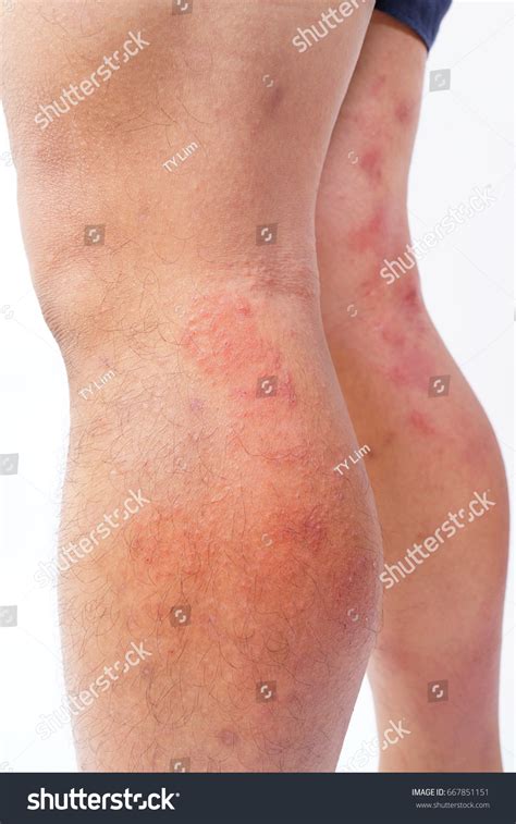 Allergic Rash Dermatitis Eczema Skin Patient Stock Photo 667851151