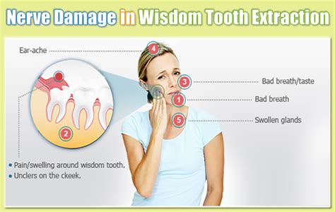 Paresthesias Nerve Damage After Wisdom Tooth Extraction
