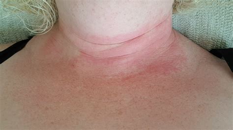 Allergic Rash On Chest