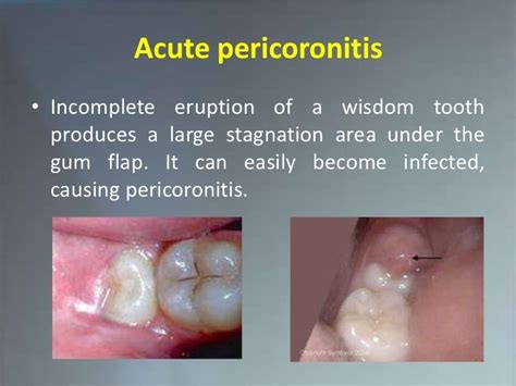 Acute Pericoronitis