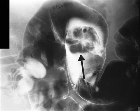 Imaging And Findings Of Lipomas Of The Gastrointestinal Tract Ajr