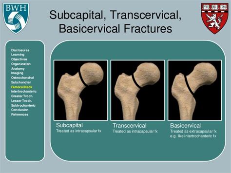 Proximal Femur Fractures - by Jeffrey Shyu, MD