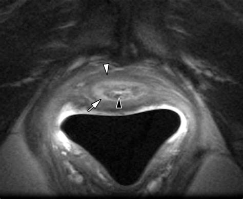 Imaging Of Female Urethral Diverticulum An Update Radiographics