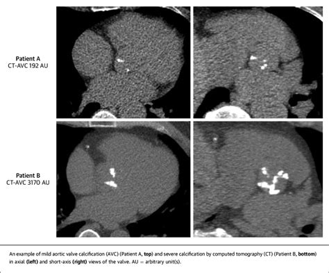 Ct Calcium Scoring Of The Aortic Valve Download Scientific Diagram