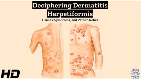 Dermatitis Herpetiformis Explained Symptoms Triggers And Relief Youtube