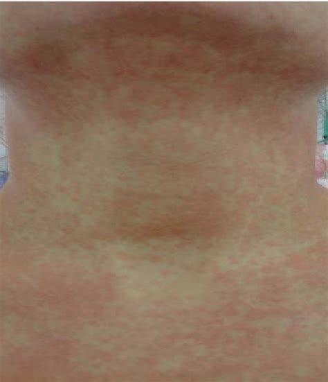 Figure 2 From Drug Rash With Eosinophilia And Systemic Symptoms Dress