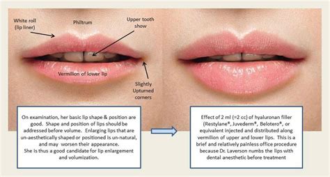 Differentiate Between Augmenting Volume Of Lips And Improving Shape Of